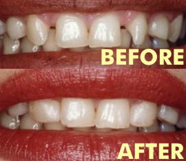 Cosmetic Dentistry by Michael Shashaty, DDS in Encino